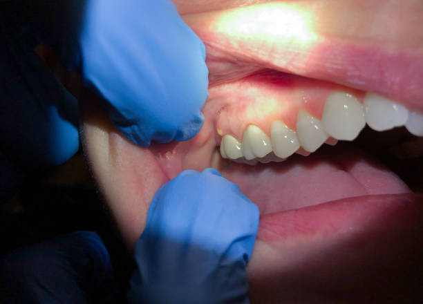Best Emergency Dental Care for Broken or Chipped Teeth in Centerburg, OH